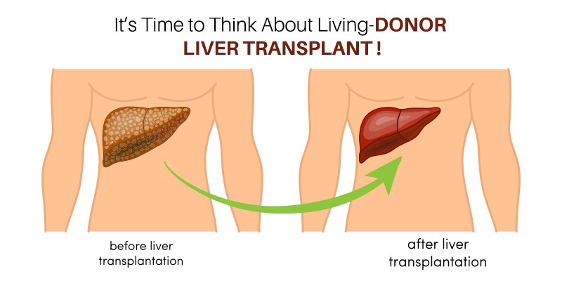 It’s Time to Think About Living-Donor Liver Transplant!