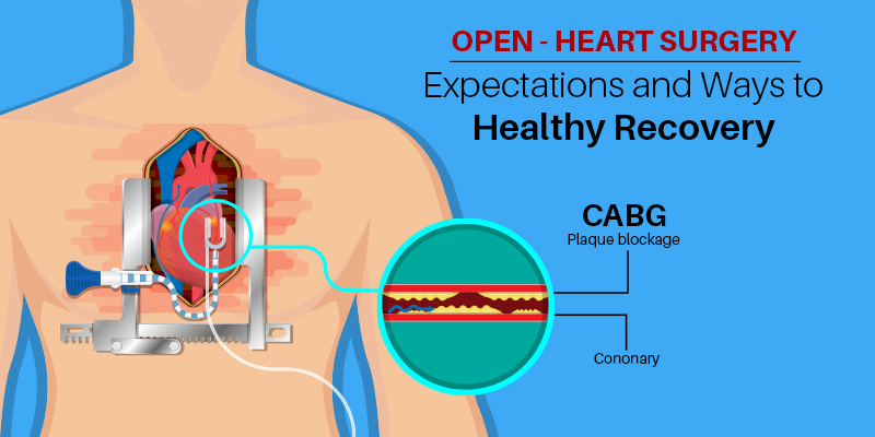 Open-Heart Surgery – Expectations and Ways to Healthy Recovery