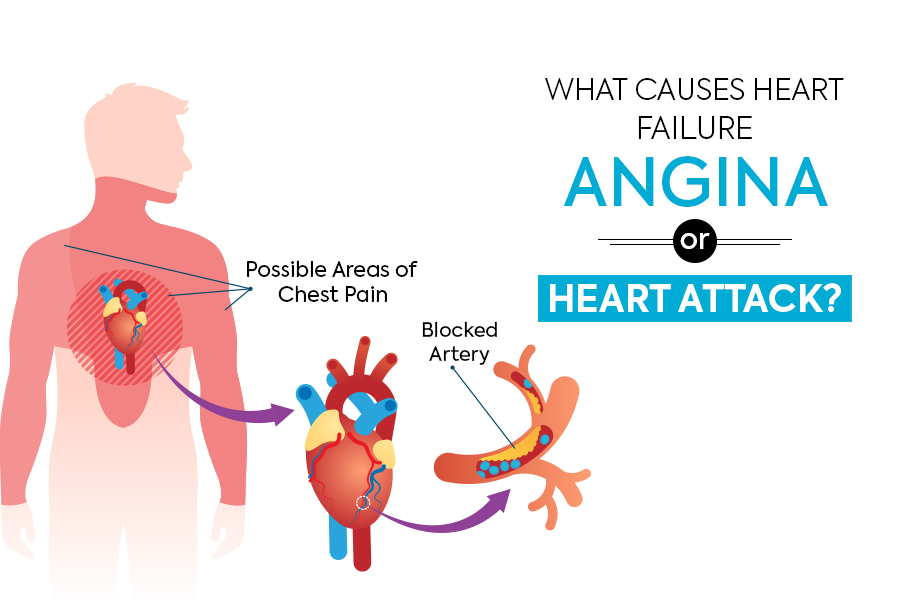 What Causes Heart Failure – Angina Or Heart Attack?