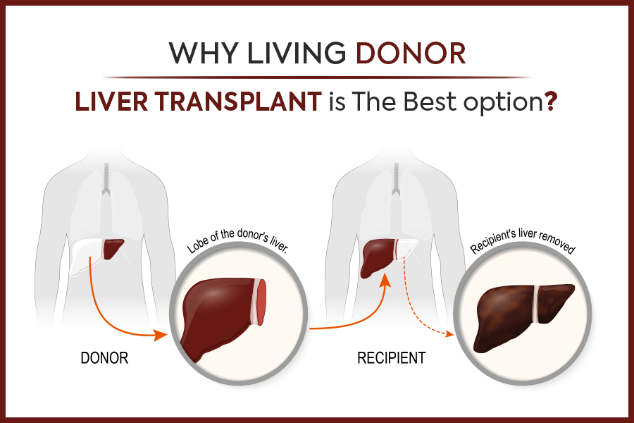 Wondering Why Living Donor Liver Transplant Is The Best Option? Here’s Why